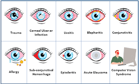 Image result for Acute Red Eye