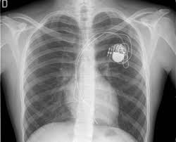 Many devices combine a pacemaker and icd in one. X Ray Of An Implanted Heart Pacemaker Damnthatsinteresting