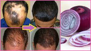 The reviews i read on the benefits of onion juice on hair left me amazed. Onion Juice For Hair Regrowth Before And After Onion Hair Oil Fast H Onion Juice For Hair Fast Hair Regrowth Hair Remedies For Growth