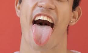 Image result for brown tongue symptoms