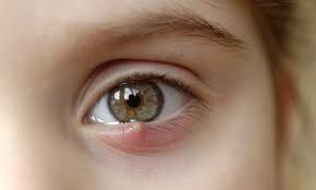 What Is A Stye And How Do You Treat Them? | Florida Vision