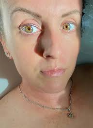 Partial Heterochromia and Unique Eye Colors