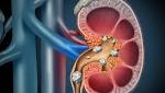  Oral Antibiotics May Increase Risk for Kidney Stones