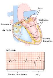 On an electrocardiogram, or ecg, which measures the electrical activity of the heart via electrodes that are placed on the skin, the atrial depolarization and its. Premature Ventricular Contractions Saint Luke S Health System