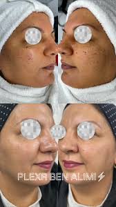 📌 PLEXR YÖNTEMİ ile Ben, Çatlak ve Cilt Yenileme Tedavisi, 🔹 Plexr  Yöntemi, maddenin 4. hâli olan plazma enerjisi ile çalışan, cerrahi  içermeyen ileri düzey bir medikal estetik uygulamadır., Cihaz, ...