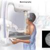 The most aggressive form of cervical cancer is small cell cervical cancer, which is also called small cell neuroendocrine carcinoma.it is a very rare type of cervical cancer. 1