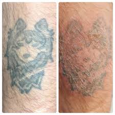 We are indianapolis laser hair removal specialists. Amazing Tattoo Removal Fort Wayne Service Grade A Tattoos