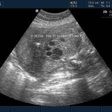 Bilateral Polycystic Kidney In Utero Eurorad