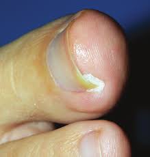 Image result for Akutní zánět nehtového lůžka