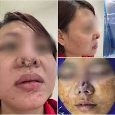 Hàng loạt biến chứng đáng sợ khi phẫu thuật thẩm mỹ, nhìn thôi cũng thấy  "đau rụng rời"