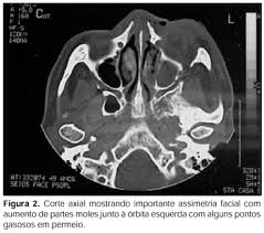 A mucormicose é uma infecção rara, provocada por um fungo, e tem acometido milhares de pacientes com coronavírus na índia. Scielo Brasil Mucormicose Rinocerebral Apresentacao De Caso Com Sobrevida E Revisao De Literatura Mucormicose Rinocerebral Apresentacao De Caso Com Sobrevida E Revisao De Literatura