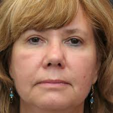 TOP 10 BEST Mole Removal near Auburn, MA