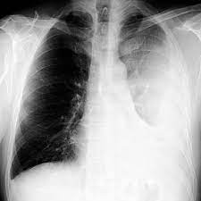 Pleural effusion is a lung condition characterized by fluid buildup outside the lungs. Large Loculated Pleural Effusion 1 Of 3