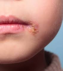 Image result for yellow scabs on the face in children