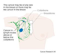 Sometimes the cancer cannot be found in the breast. Stage 3 Breast Cancer Cancer Research Uk