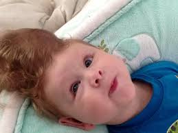 Baby born with brain outside his head: Photos reveal incredible story