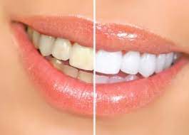 Teeth Whitening Cost in Karachi Affordable | Rehan Dental Surgery