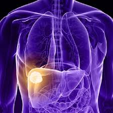 But sometimes liver cancer happens in people diagnosis, staging and management of hepatocellular carcinoma: Tace Treatment Improves Outcomes In Liver Cancer Cancerconnect