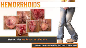 Image result for hemoroid human