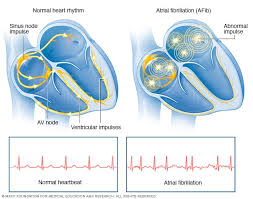 Bending over change in blood pressure, loud noìses, emotional disturbances, acid reflux and cold drinks. Atrial Fibrillation Symptoms And Causes Mayo Clinic