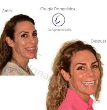 Cirugia Ortognatica