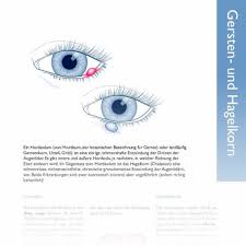 Eine schwellung am augenlid, siehe chalazion. Gersten Und Hagelkorn Paediatrieinfo