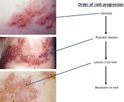 Image result for herpes zoster
