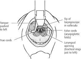 Image result for Rapid Sequence Induction