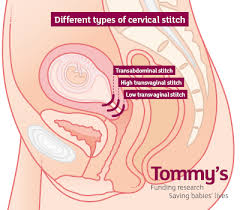 Your mucus plug will prepare itself for pregnancy. Preventing A Premature Birth Treatment Tommy S