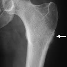 Image result for Chondrosarcoma