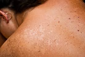 Desde problemas de pigmentación, pasando por inconvenientes de todas formas, estos remedios caseros suelen ser muy empleados para combatir las manchas oscuras, blancas y rojas, como así. 6 Buenos Remedios Naturales Para Aliviar Las Quemaduras Solares Mejor Con Salud