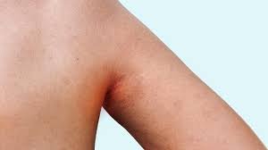 Inverse Psoriasis Hidden But Painful Everyday Health