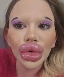 The girl with the world's biggest lips is making headlines again—this time,  she's transforming yet another part of her face! 👀 Curious to see the  latest change? Check out her bold new