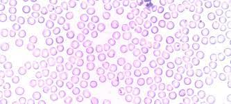 Ce sfat ar trebui sa urmez eu am limfocitele 47.40 si monocitele 9.30.exista ceva grav?? Monocite Crescute Sau Scazute Cauze Si Simptome Mami Si Copilul