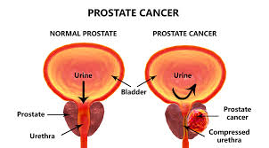 See more ideas about prostate, prostate health, enlarged prostate. Prostate Massage Explained Tantric Healing Therapy
