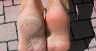 Oui Le Bicarbonate De Soude Permet D Eliminer Les Talons Crevasses Et Avoir Une Peau Douce Voici Comment L Utiliser Pied Sec Corne Sous Les Pieds Corne Pieds