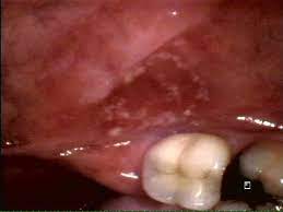 Leukoplakia is cancer or not? Oral Leukoplakia Dermatology Advisor
