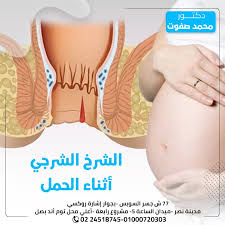 مركز علاج البواسير بدون جراحة2 المنشورات فيسبوك