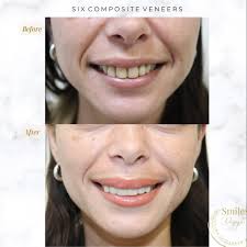 Our lovely patient came in for composite veneers to improve, brighten and  align her smile 🎨🦷 Here's to a stunning and confident smile 🤩✨