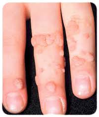 Image result for verrucae filiformes