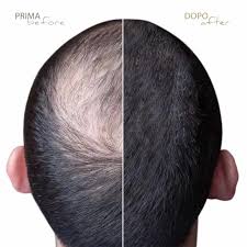 Di dover smettere le cure volta eseguita la micro pigmentazione. Tricopigmentazione Un Valida Alternativa Al Trapianto Capelli