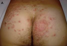 Although it cannot completely prevent this condition it may help lessen the severity of it. Folliculitis Causes Signs Symptoms How To Get Rid Of Folliculitis