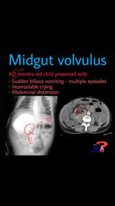 Image result for Midgut Volvulus