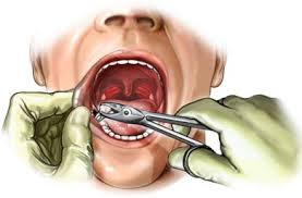 Zuerst wird der zahnarzt über den eingriff aufklären, danach untersucht er die betroffene stelle und führt die behandlung durch. Zahnextraktion Zahne Ziehen Zahnarzt Dr Seidel