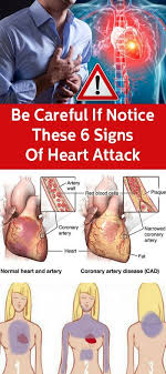 Signs Of Heart Attack That You Have To Know Signs Of Heart Attack Heart Attack Coronary Artery Disease