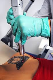 Laser Removal Laser Tattoo Removal