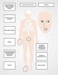 Fragile X Syndrome