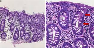 Image result for Microscopic Colitis