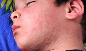 Hives In Toddlers Should You Worry Blackwood Family Medicine