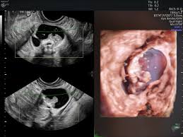 Some of them are produced by both normal and cancerous ovarian cells, so ovarian cancer is. What 3d Ultrasound Can Tell You About Ovarian Cancer Empowered Women S Health